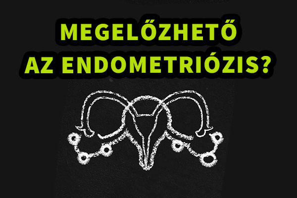 Megelőzhető-e az endometriózis? - Videóval!